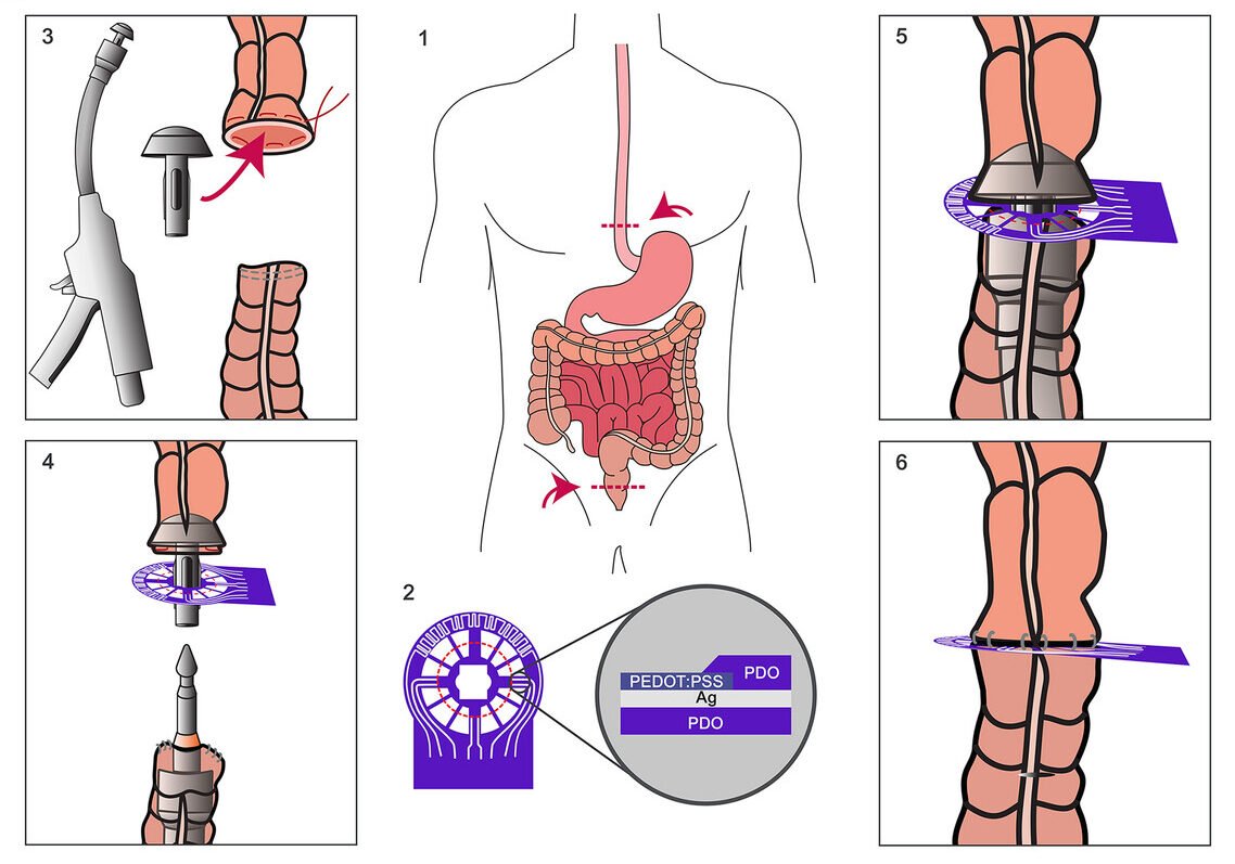 Small Intestine Sensor New Sensor Technology Detects Complications After Intestinal Surgery ...